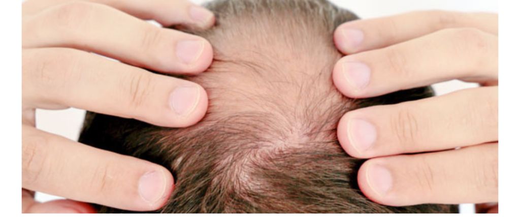 Understanding Hair Fall: Causes, Diet and Preventive Measures 1000024582 1024x427